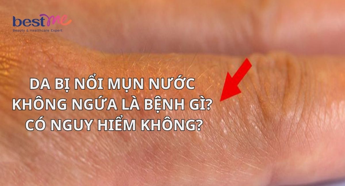 Da bị nổi mụn nước không ngứa là bệnh gì? Có nguy hiểm không?