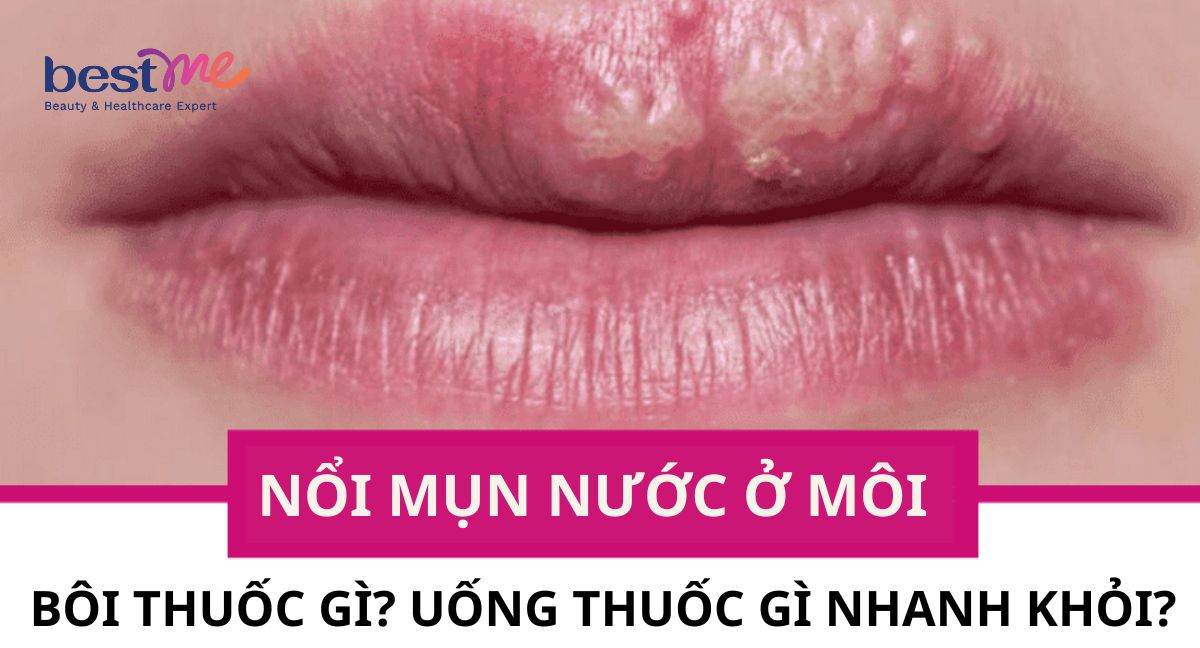 Bị nổi mụn nước ở môi bôi thuốc gì? Uống thuốc gì nhanh khỏi?