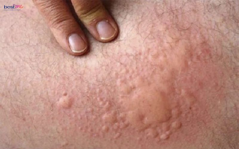 noi-mun-nuoc-o-mong-la-benh-gi-cach-tri-xu-ly-nhu-the-nao-1 Nổi mụn nước ở mông là bệnh gì? Cách trị xử lý như thế nào? - 1