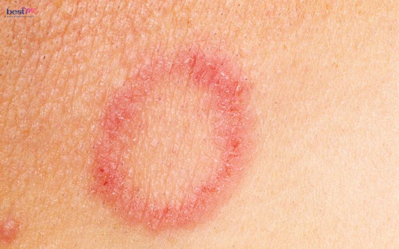 noi-mun-nuoc-o-mong-la-benh-gi-cach-tri-xu-ly-nhu-the-nao-5 Nổi mụn nước ở mông là bệnh gì? Cách trị xử lý như thế nào? - 5