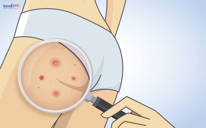 noi-mun-nuoc-o-mong-la-benh-gi-cach-tri-xu-ly-nhu-the-nao-8 Nổi mụn nước ở mông là bệnh gì? Cách trị xử lý như thế nào? - 8
