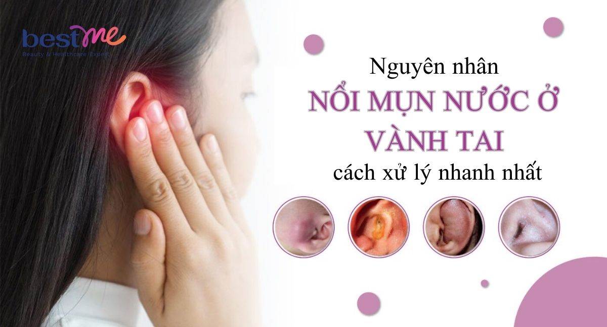 Nguyên nhân nổi mụn nước ở vành tai và cách xử lý nhanh nhất