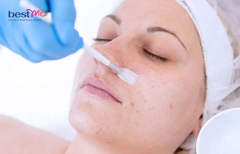 Quy trình peel da retinol