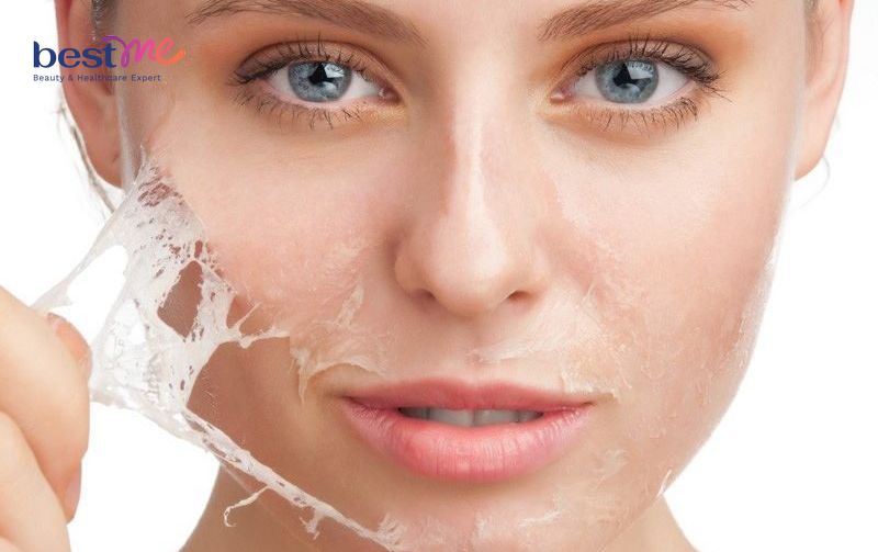 Peel da retinol là cách thay da sinh học