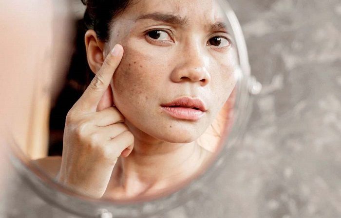 Người có làn da thâm nám nên peel da