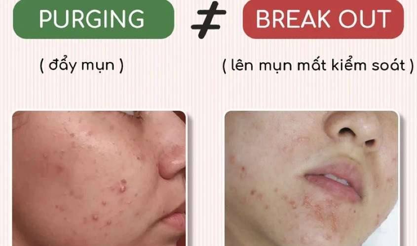 Sự khác biệt giữa đẩy mụn và nổi mụn do dị ứng
