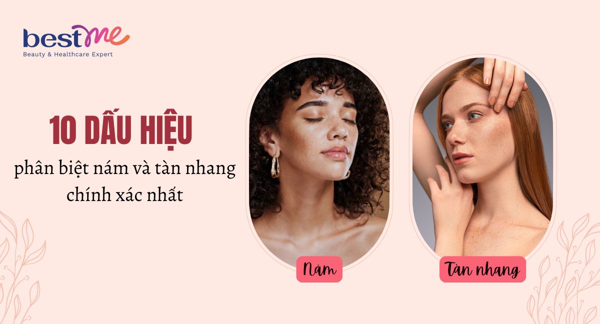 10 dấu hiệu phân biệt nám và tàn nhang chính xác nhất