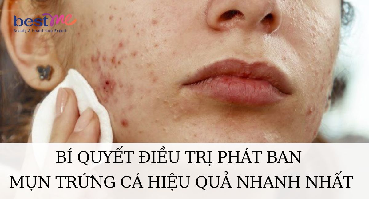 Nguyên nhân và cách điều trị phát ban mụn trứng cá hiệu quả