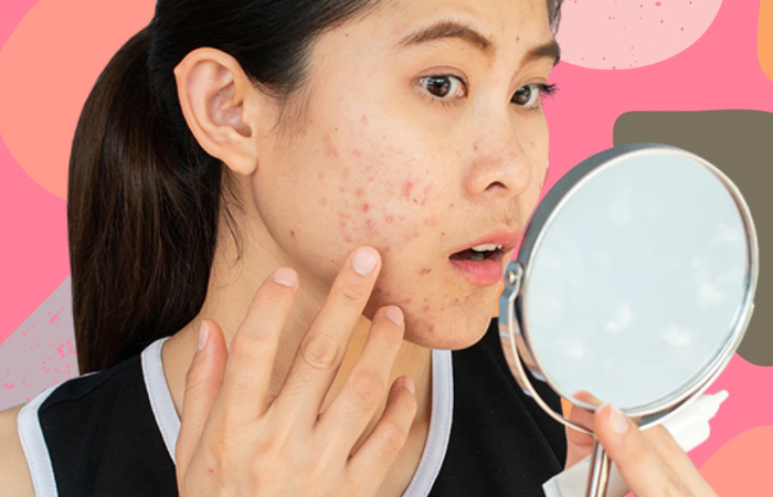 Da mụn vô cùng “khó chiều”