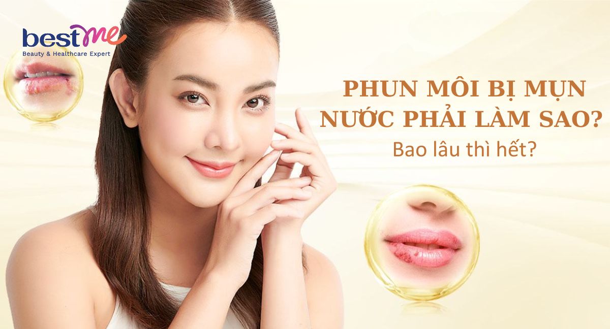 Xăm, phun môi bị mụn nước bao lâu thì khỏi? Làm sao nhanh hết?