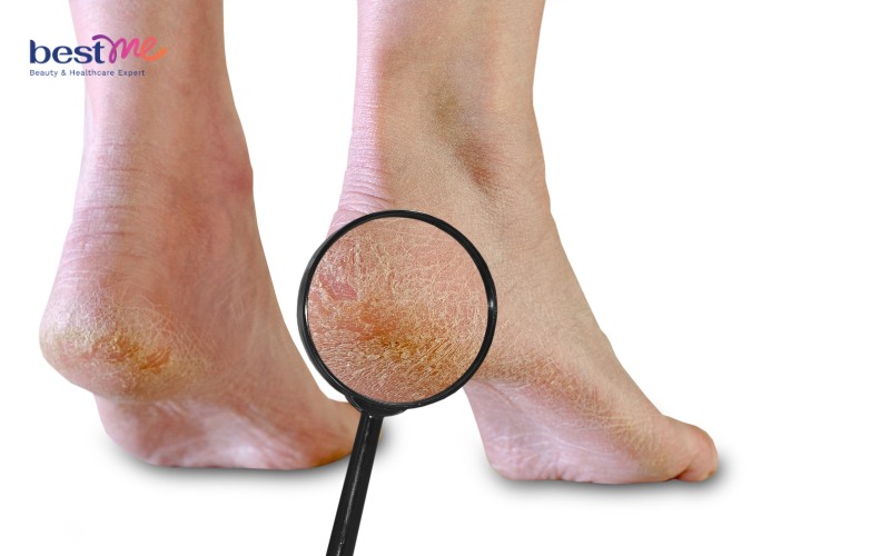 Người có gót chân khô nẻ nên sử dụng kem dưỡng da chân DHC Urea Cream