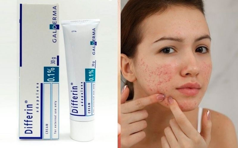 review-kem-tri-mun-differin-gia-bao-nhieu-co-tot-khong-1 Review kem trị mụn Differin giá bao nhiêu? Có tốt không? - 1