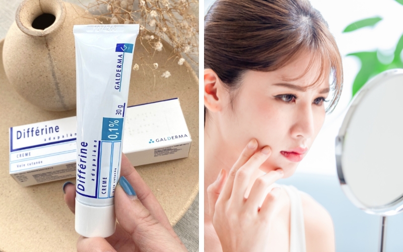 review-kem-tri-mun-differin-gia-bao-nhieu-co-tot-khong-3 Review kem trị mụn Differin giá bao nhiêu? Có tốt không? - 3
