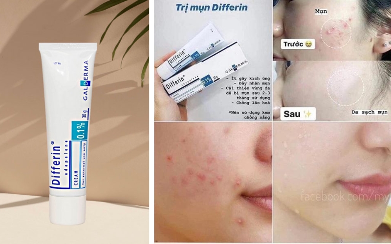 review-kem-tri-mun-differin-gia-bao-nhieu-co-tot-khong-5 Review kem trị mụn Differin giá bao nhiêu? Có tốt không? - 5