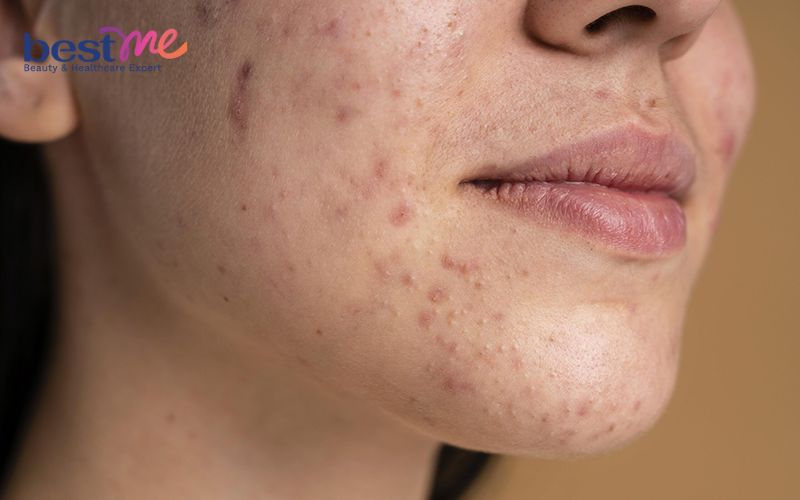 review-laser-tri-tham-mun-co-tot-khong-gia-bao-nhieu-tien-1 Review laser trị thâm mụn có tốt không? Giá bao nhiêu tiền? - 1