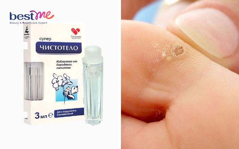 review-thuoc-tri-mun-coc-cua-nga-gel-dvelinil-co-tot-khong-6 Review thuốc trị mụn cóc của Nga Gel Dvelinil có tốt không? - 6