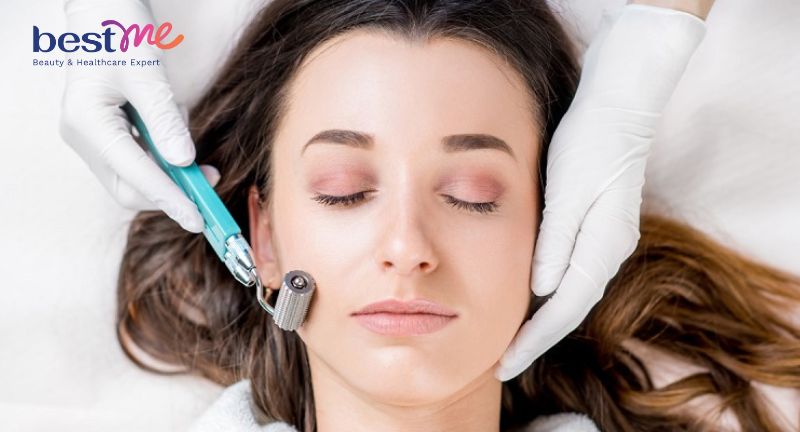 Sau khi lăn kim da mặt như thế nào? Có hại không? Kiêng gì?