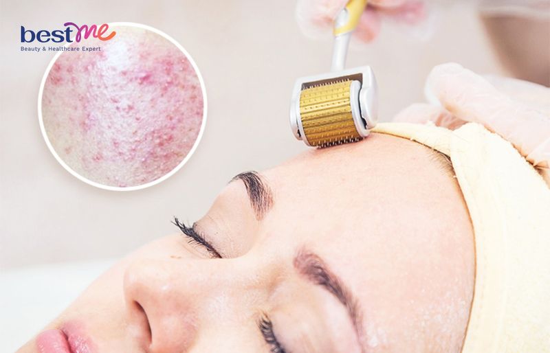 Lăn kim giúp điều trị mụn