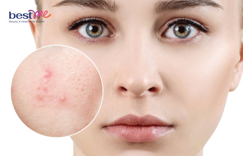 Thành phần B3 có trong serum giúp cải thiện tình trạng sần sùi da
