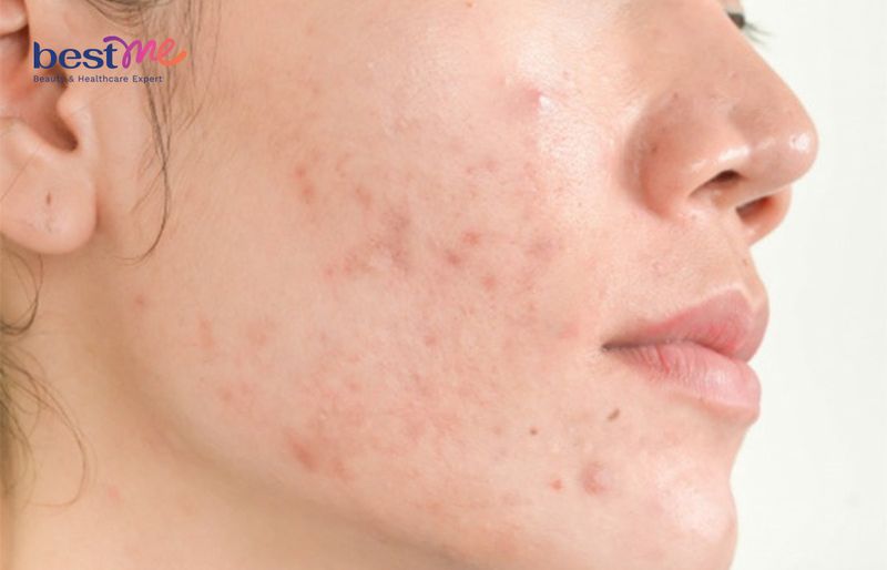 Review chi tiết nhất Serum phục hồi da La Roche-Posay Hyalu B5 - 2