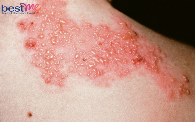 Sốt nổi mụn nước ở người lớn, trẻ em là bệnh gì? Cách điều trị - 1