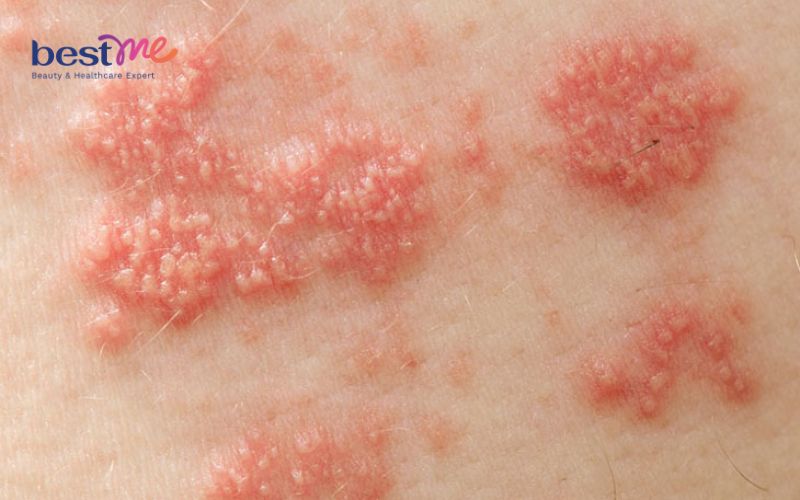 Sốt nổi mụn nước ở người lớn, trẻ em là bệnh gì? Cách điều trị - 2