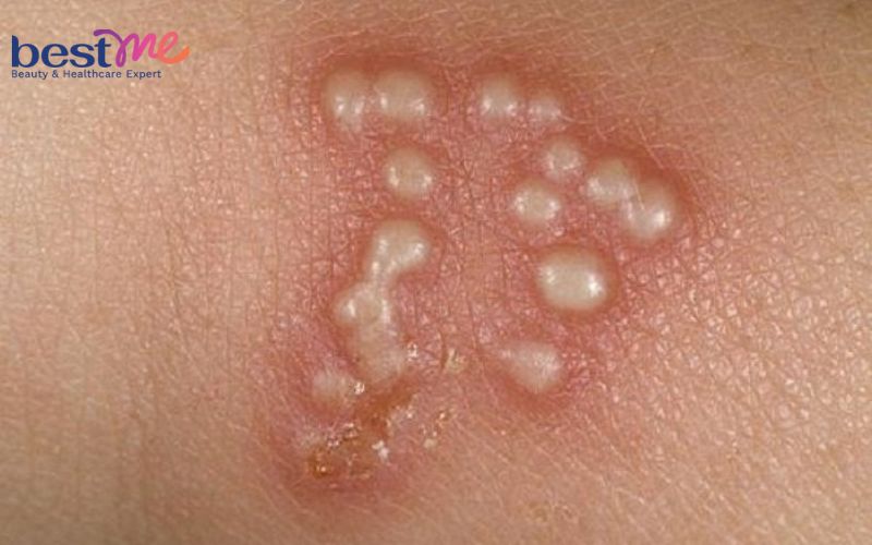 Sốt nổi mụn nước ở người lớn, trẻ em là bệnh gì? Cách điều trị - 3