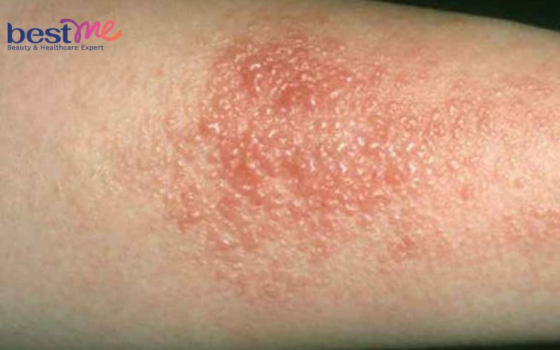 Sốt nổi mụn nước ở người lớn, trẻ em là bệnh gì? Cách điều trị - 4