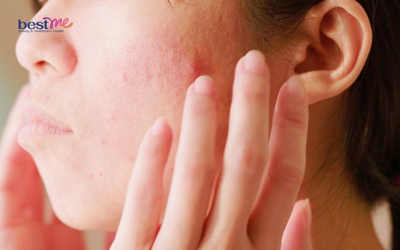 Sử dụng sản phẩm chống nắng không nên dùng khiến da bị tổn thương