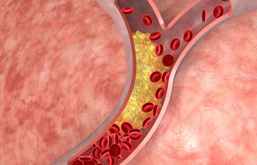 Chất xơ có khả năng làm giảm cholesterol xấu trong cơ thể