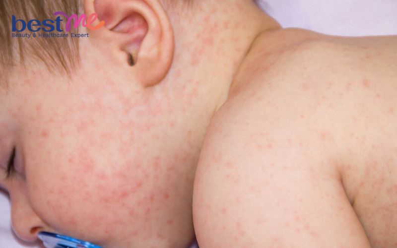 Người bị thiếu hụt biotin bẩm sinh