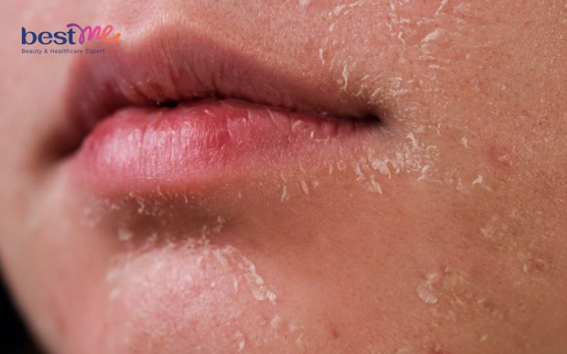 Tại sao bôi kem chống nắng bị vón cục? Hướng dẫn cách bôi đúng - 4