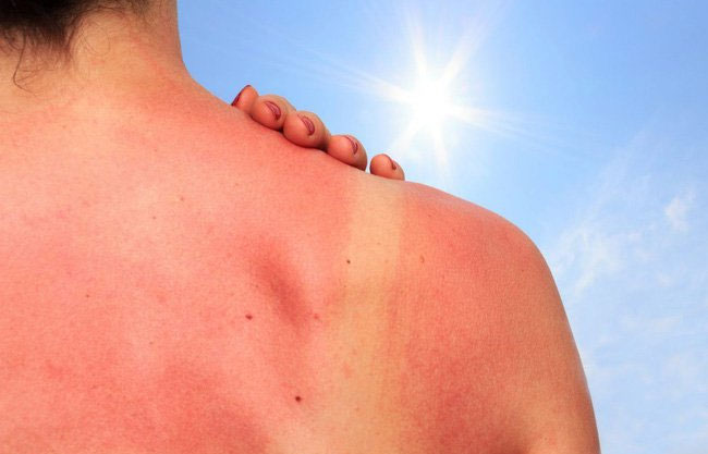 Cháy nắng thường do làn da tiếp xúc với ánh nắng mặt trời trong thời gian dài