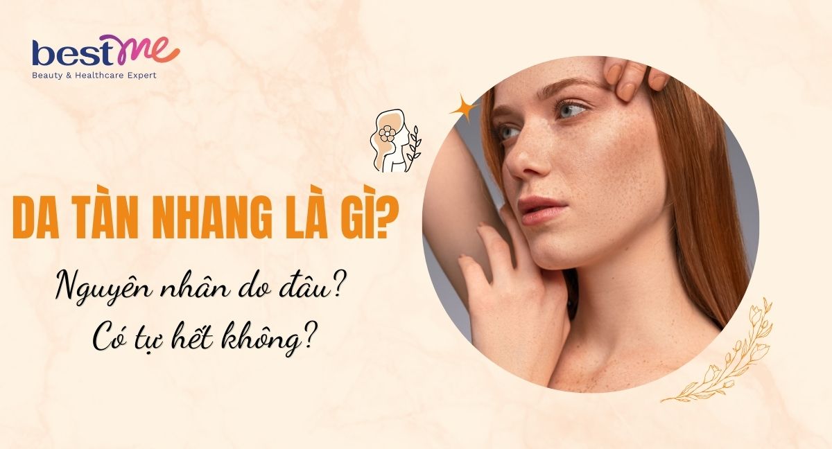 Da tàn nhang là gì? Nguyên nhân do đâu? Có tự hết không?