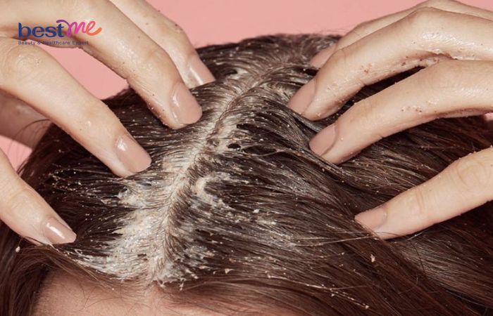 Để có một mái tóc khỏe đẹp và nhanh dài hơn, tẩy tế bào chết da đầu là một bước chăm sóc quan trọng mà bạn không nên bỏ qua