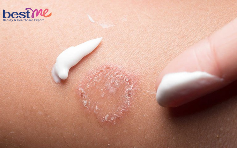 Azole là một nhóm thuốc kháng nấm được sử dụng rộng rãi trong điều trị vi nấm trên mặt