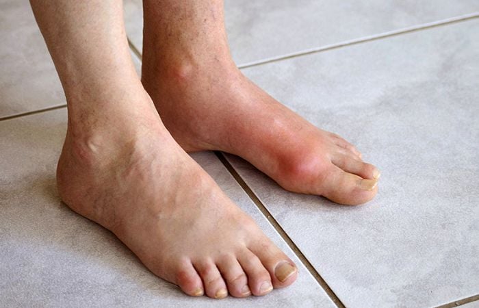 Bệnh gout là một dạng viêm khớp do rối loạn chuyển hóa purin làm tăng axit uric máu