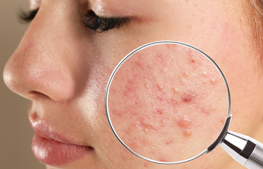 Giãn mao mạch do da bị viêm