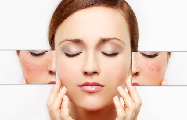 Tình trạng giãn mao mạch trên da