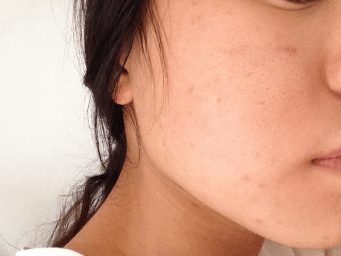 8 Cách xử lý da mặt sần sùi lỗ chân lông to cực hiệu quả cho nàng