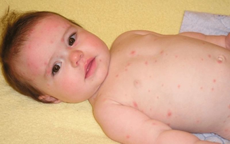 Trẻ sơ sinh bị nổi mụn nước do nhiễm trùng nấm 