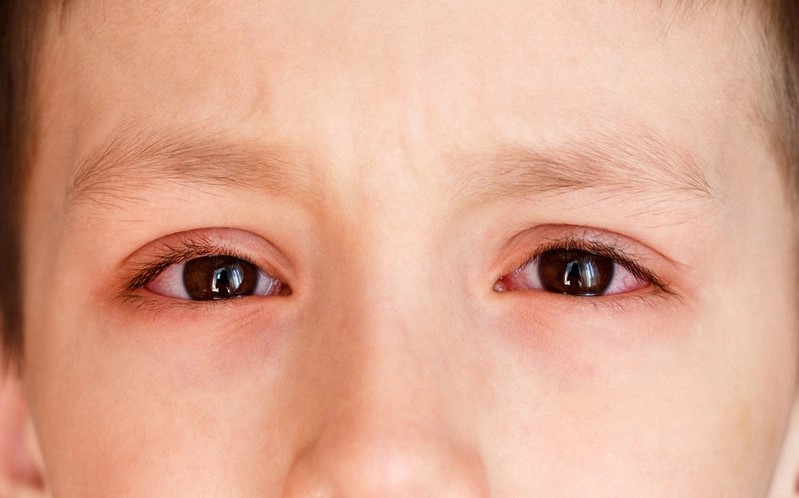 Thiếu vitamin A trẻ có thể mắc các bệnh về mắt như quáng gà, khô mắt