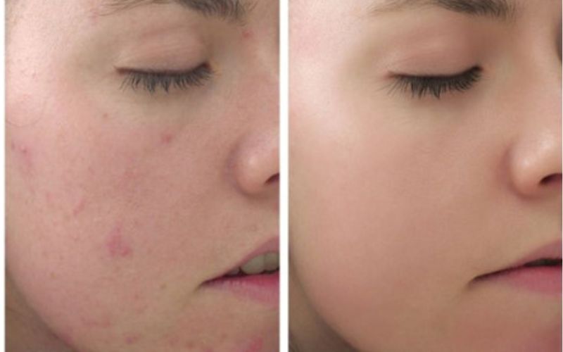 Nguyên nhân và phương pháp phục hồi da mặt bị rỗ tại nhà an toàn - 10