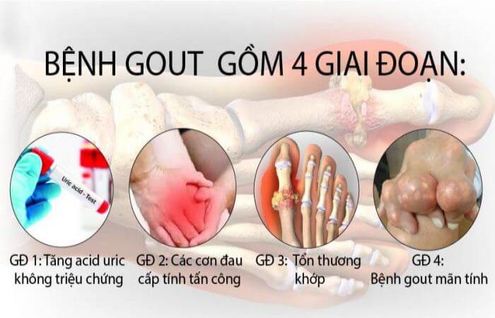 Triệu chứng trong 4 giai đoạn của bệnh gout