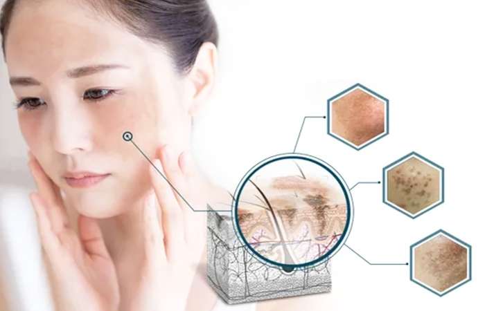 Triệu chứng của nám da rất dễ nhận biết, đó là các mảng da có màu sẫm, đậm hơn hơn bình thường, mang màu nâu hoặc xám