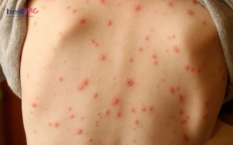 trieu-chung-noi-mun-nuoc-ngua-khap-nguoi-la-benh-gi-nen-lam-gi-10 Triệu chứng nổi mụn nước ngứa khắp người là bệnh gì? Nên làm gì? - 10