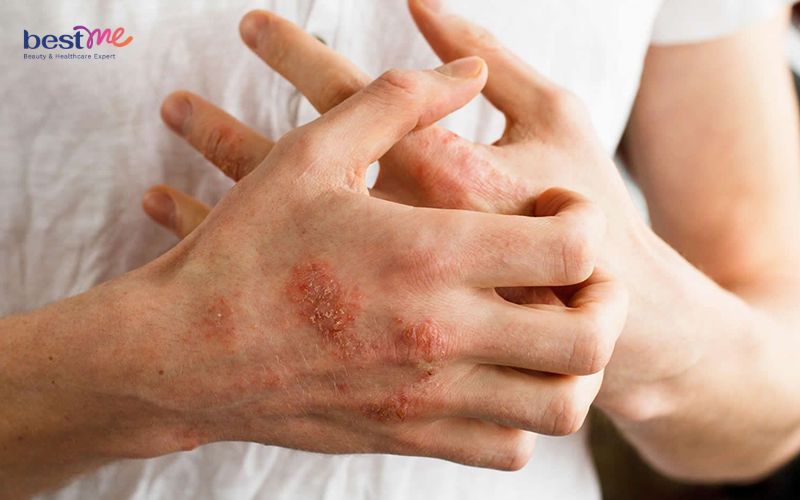 trieu-chung-noi-mun-nuoc-ngua-khap-nguoi-la-benh-gi-nen-lam-gi-11 Triệu chứng nổi mụn nước ngứa khắp người là bệnh gì? Nên làm gì? - 11
