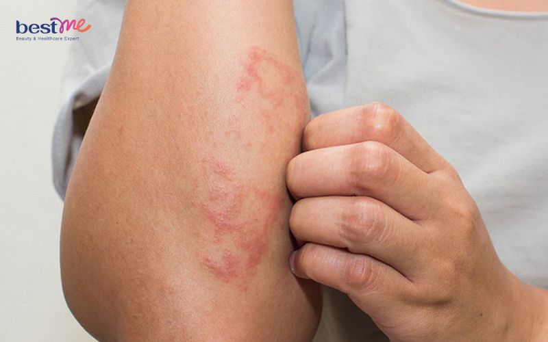 trieu-chung-noi-mun-nuoc-ngua-khap-nguoi-la-benh-gi-nen-lam-gi-4 Triệu chứng nổi mụn nước ngứa khắp người là bệnh gì? Nên làm gì? - 4