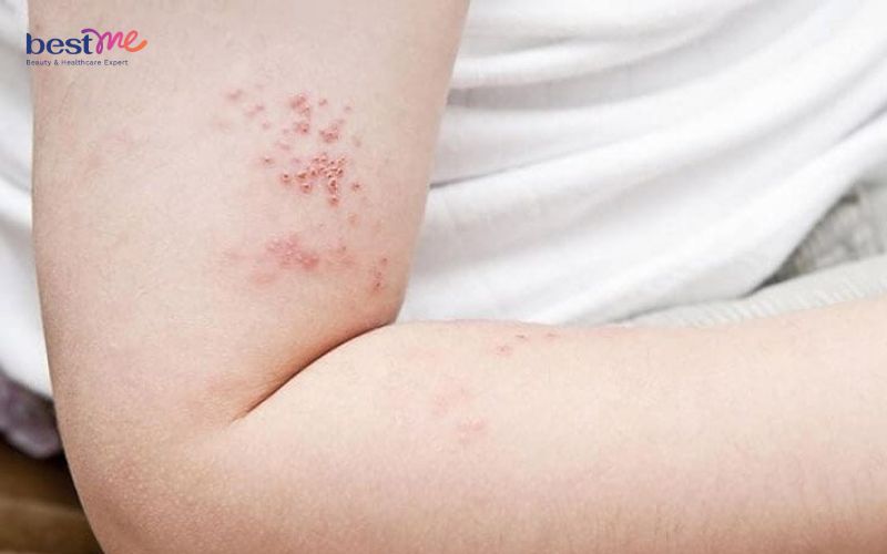 trieu-chung-noi-mun-nuoc-ngua-khap-nguoi-la-benh-gi-nen-lam-gi-7 Triệu chứng nổi mụn nước ngứa khắp người là bệnh gì? Nên làm gì? - 7