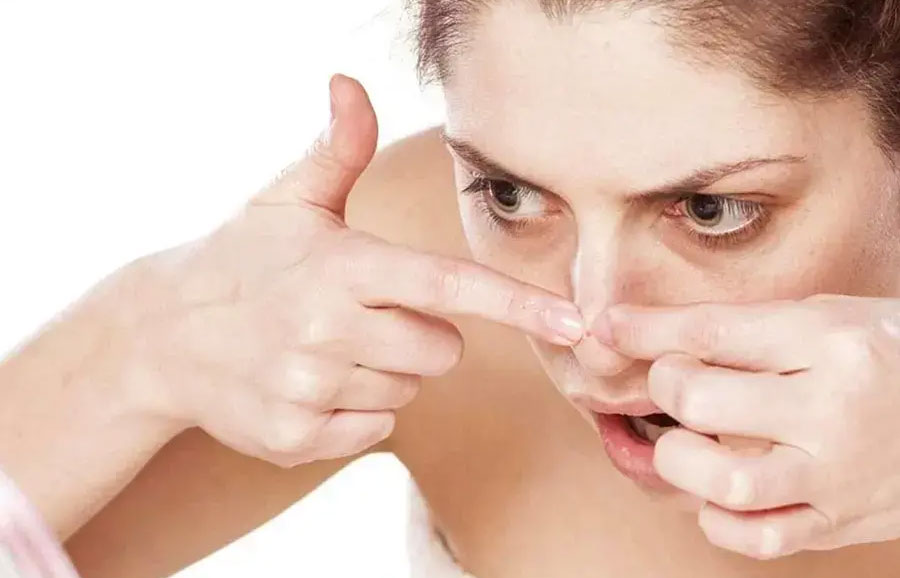 Không nên tự nặn mụn đầu đen